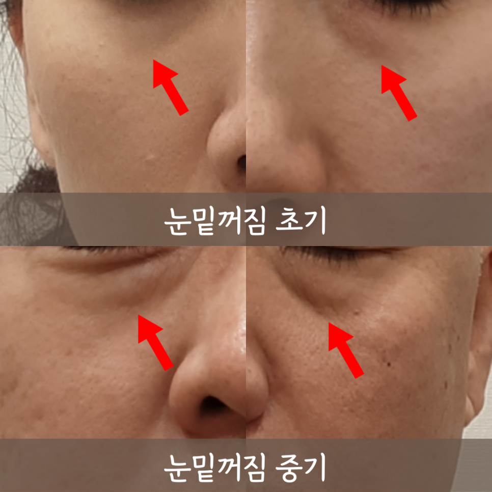 얼굴 노화의 진행 단계 - 탄력노화에서 윤곽노화로
