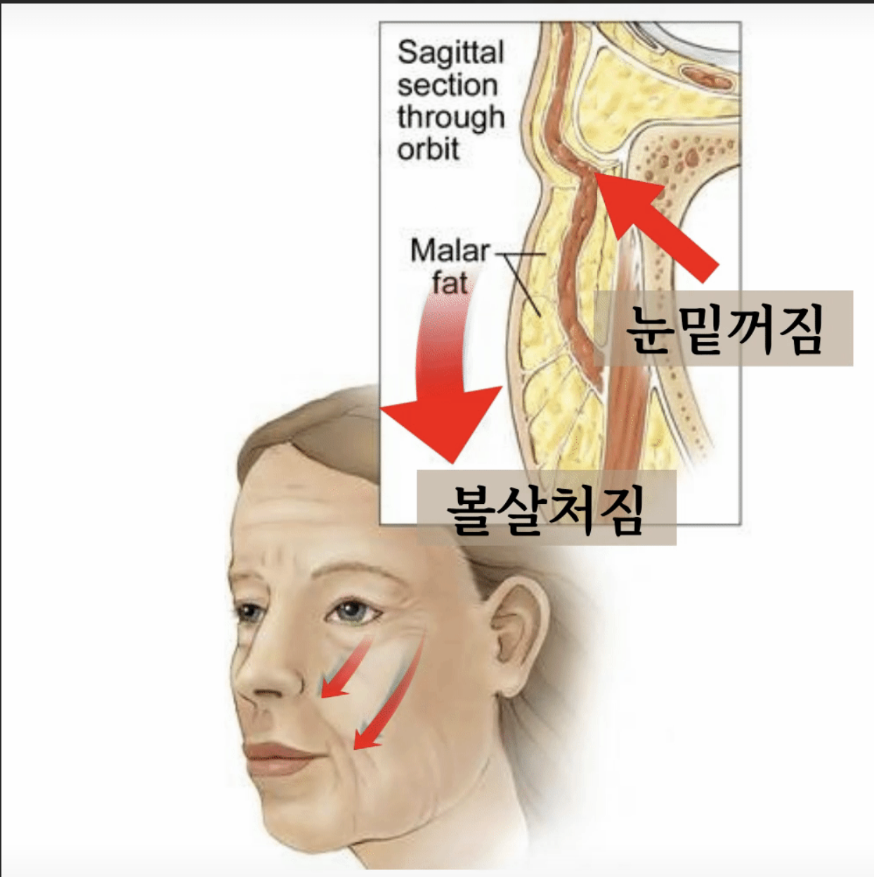 눈밑꺼짐 발생 원리 도식
