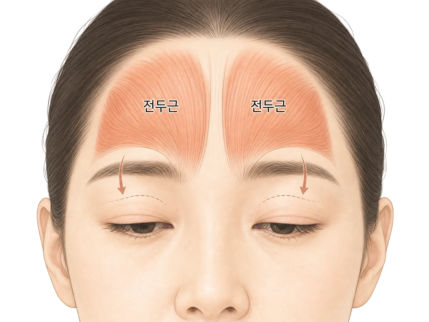 눈꺼풀 처짐