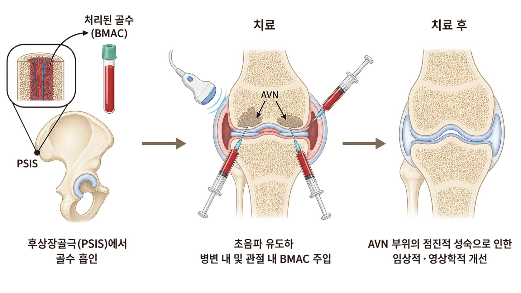 정형외과에서 사용되는 PRP