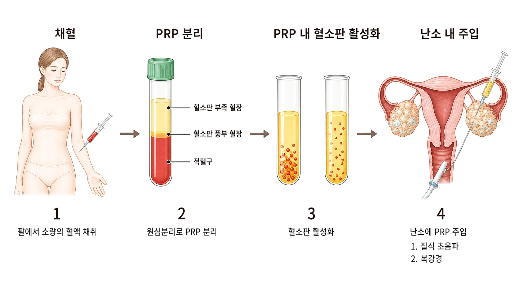 산부인과에서 사용되는 PRP