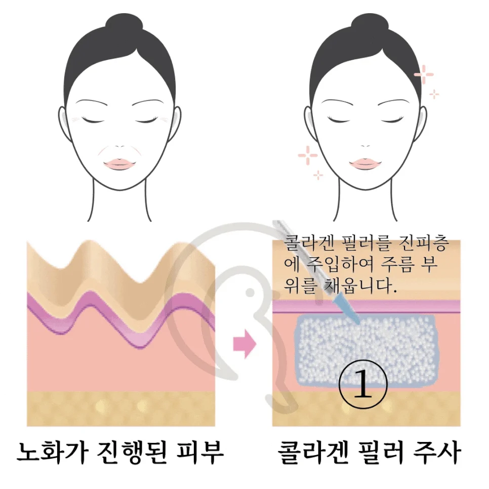 피붓결 개선 효과 스킨부스터