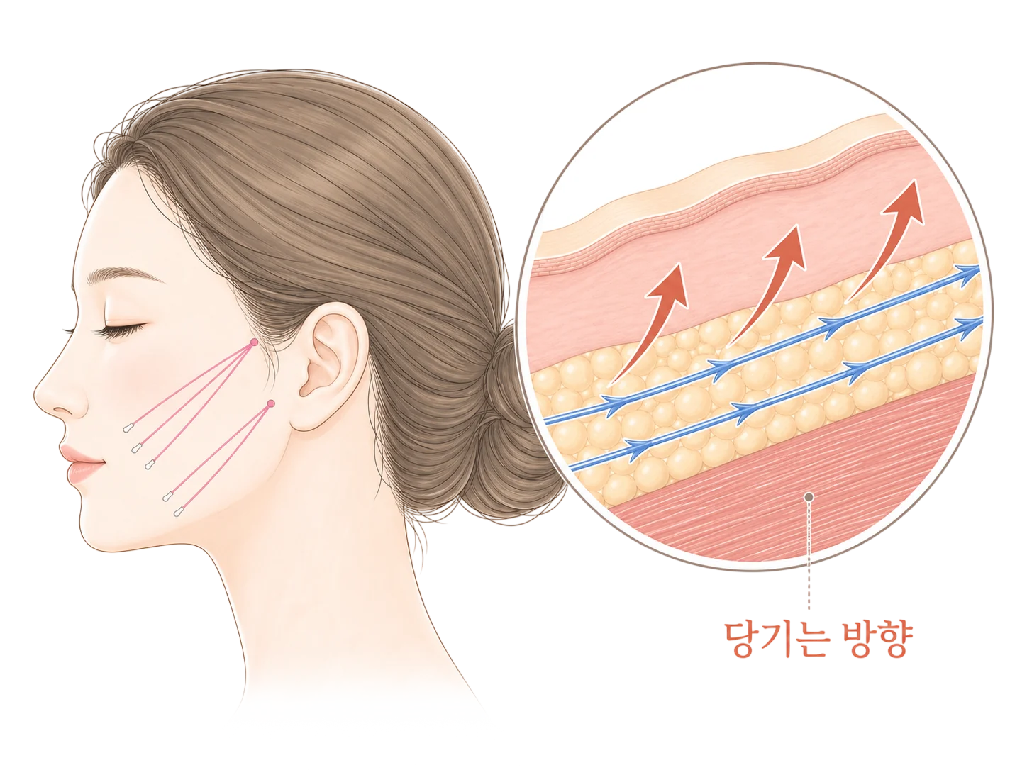 실 리프팅