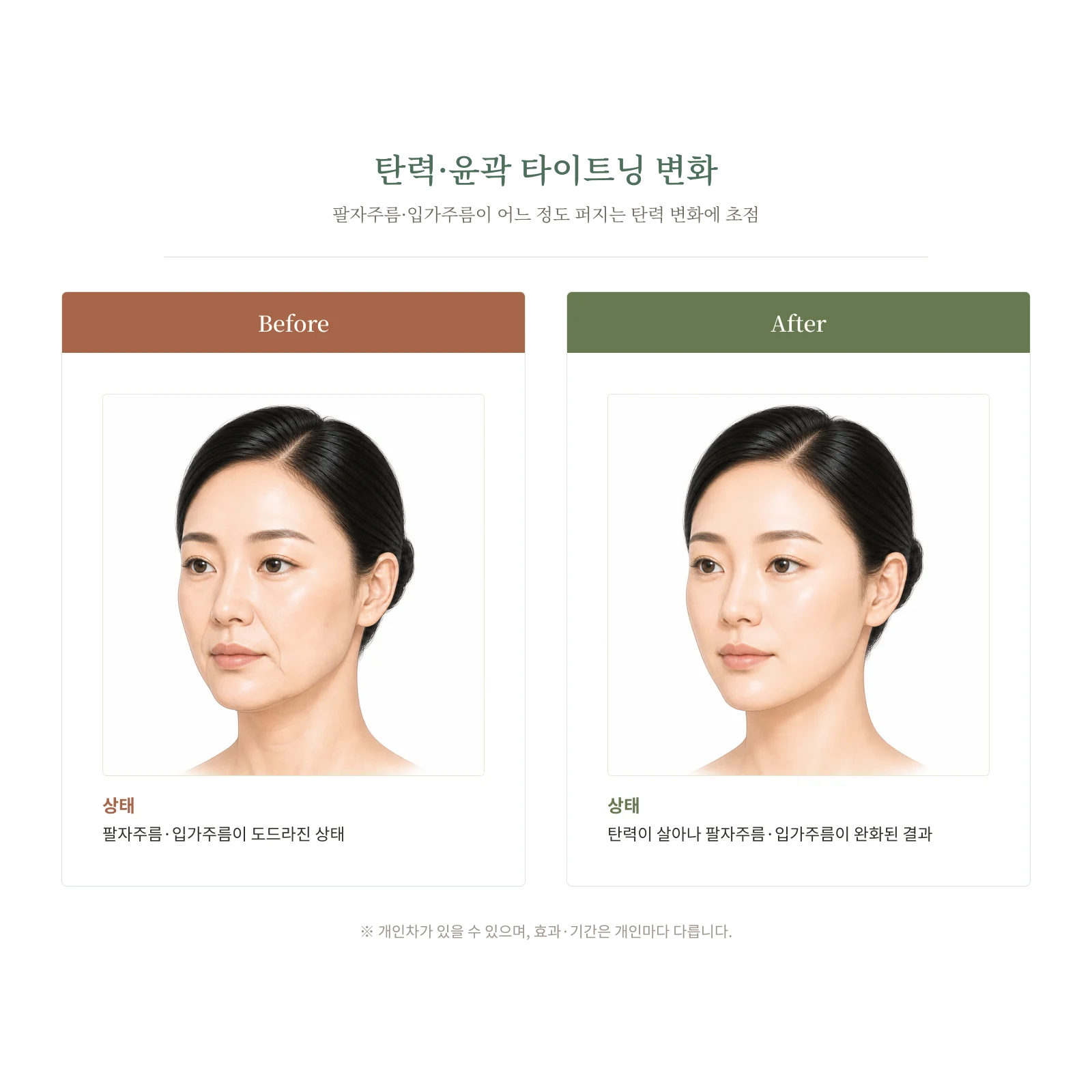 팔자주름·입가주름이 완화되는 탄력 타이트닝 변화