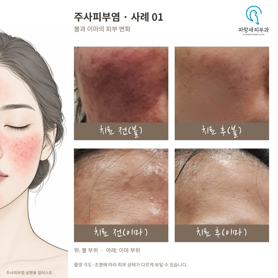 40대 여성 주사피부염 PRP·큐어젯·실펌 X 치료 전후. 각 줄 왼쪽은 치료 전, 오른쪽은 치료 후이며 위는 볼, 아래는 이마